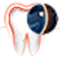 Initialkaries