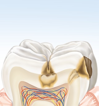 Der Zahnschmelz unter der Zahnoberfläche