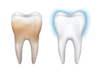 Wie können Sie Zahnschmelz-Abbau vermeiden?